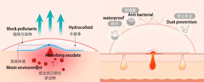 Application principle of blister plaster