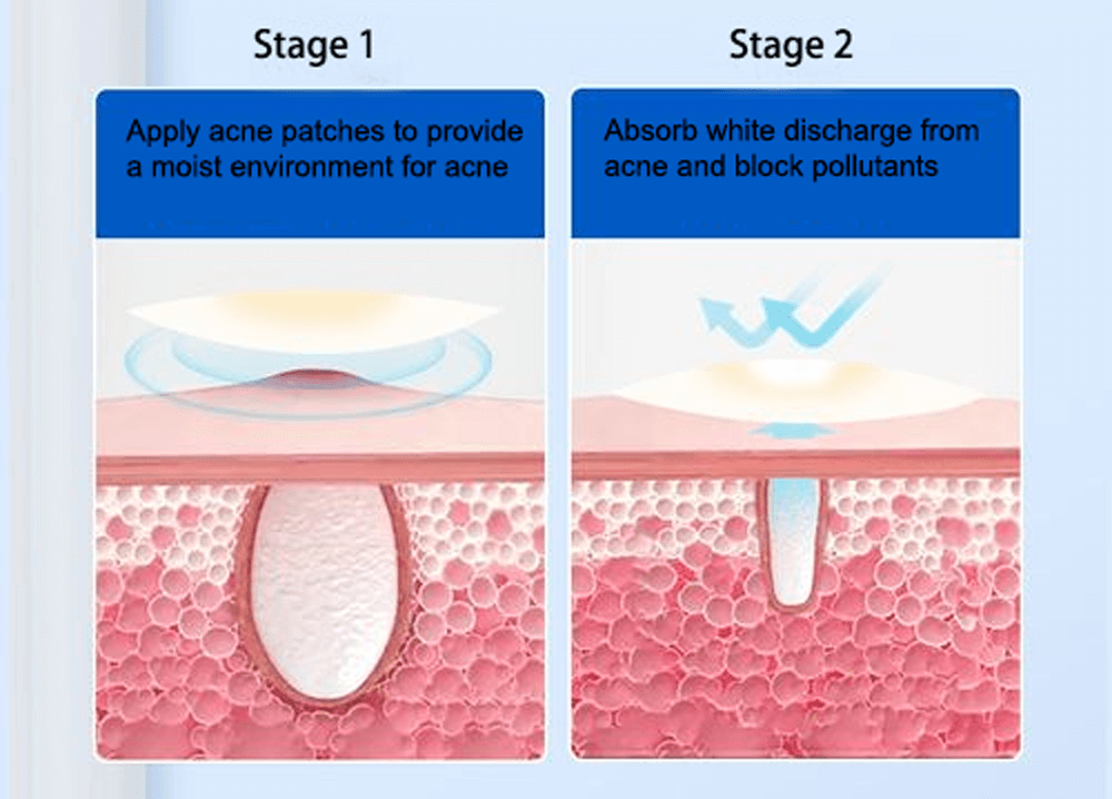 Hydrocolloid acne patch helps heal acne and small wounds. Provide instant relief from painful acnes. Keep the wound from dirt,germs and bacteria, Each patch contains a hydrocolloid island pad.