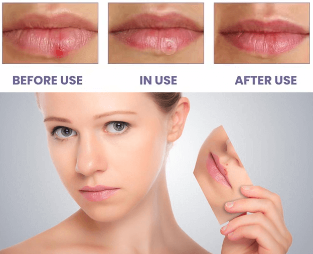 Benefits of Hydrocolloid Cold Sore Patches