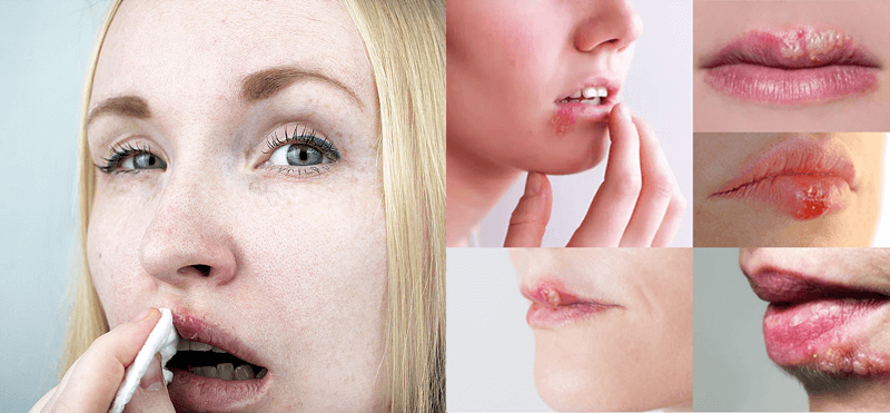 hydrocolloid cold sore patches provide a gentle and effective way to manage the symptoms of cold sores. They promote faster healing, reduce pain and discomfort.